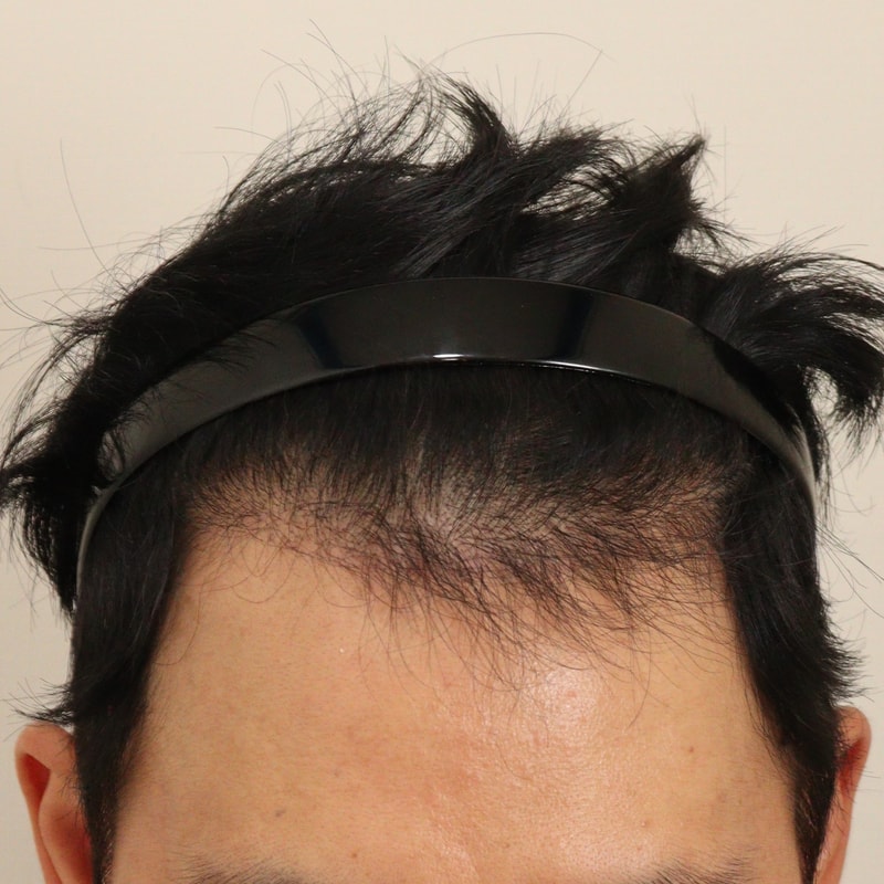 4. 수술후_6개월_2.JPG