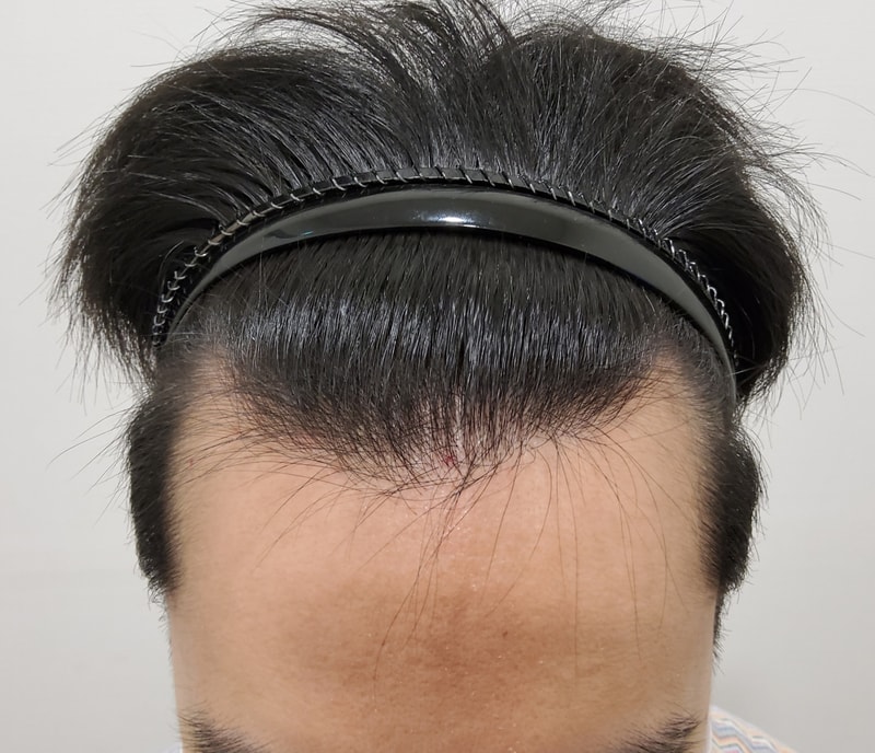 I got a hair transplant with my friend