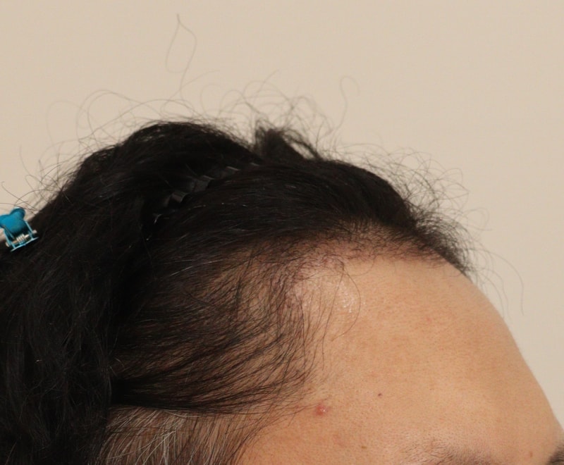 3. 수술후_3개월_2.JPG