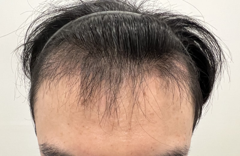 3. 수술후_3개월_1.jpg