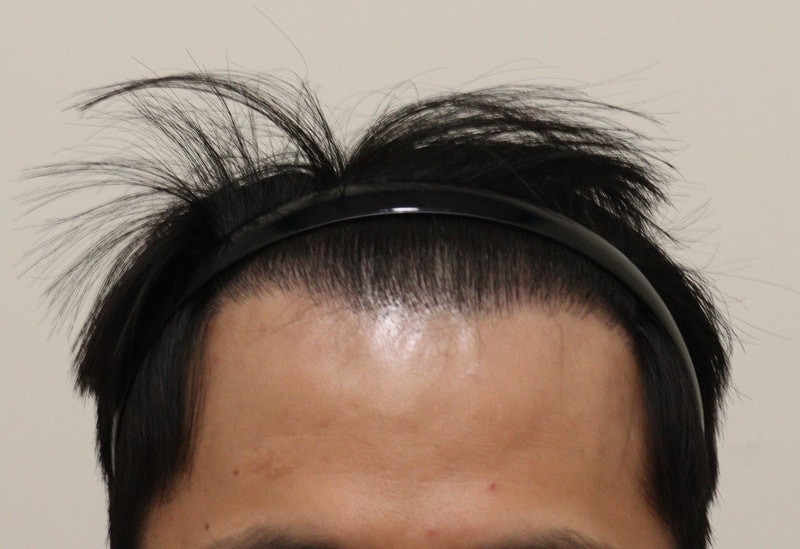 4. 수술후_6개월_1.JPG