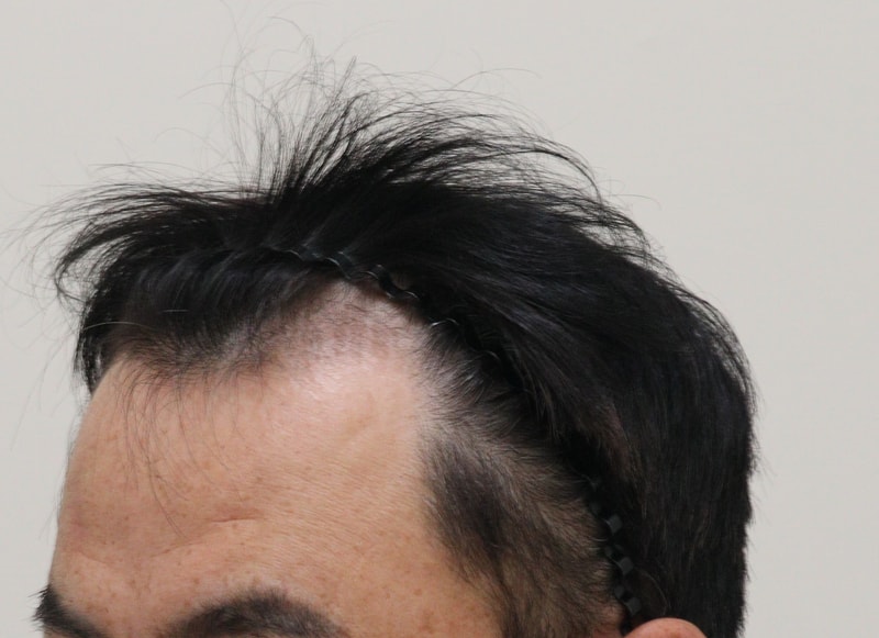 1. 수술전_2.JPG