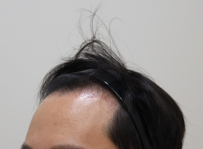 3. 수술후_3개월_2.JPG
