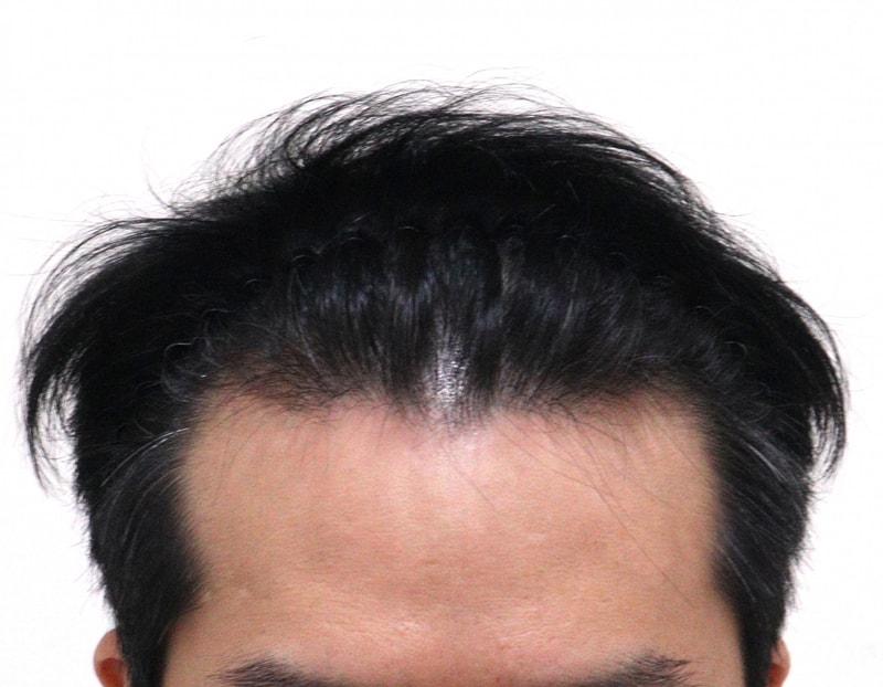 1. 수술전_1.JPG