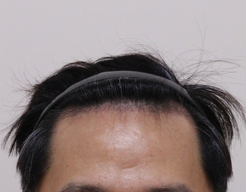 3. 수술후_3개월_1.JPG