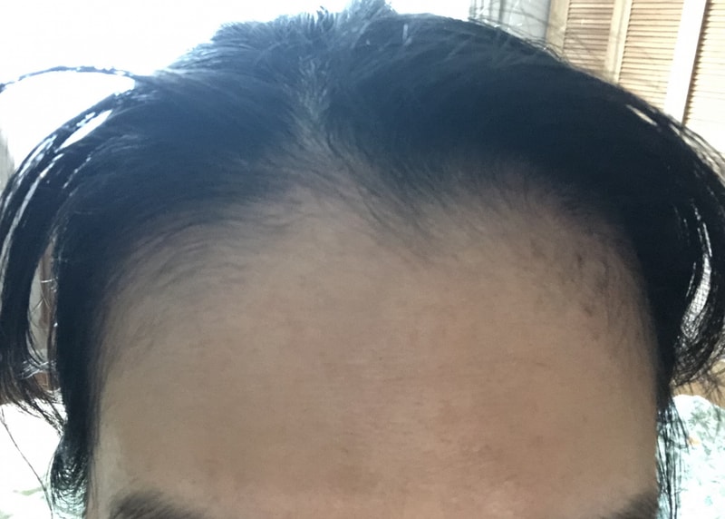 3. 수술후_3개월_셀카_1.jpg