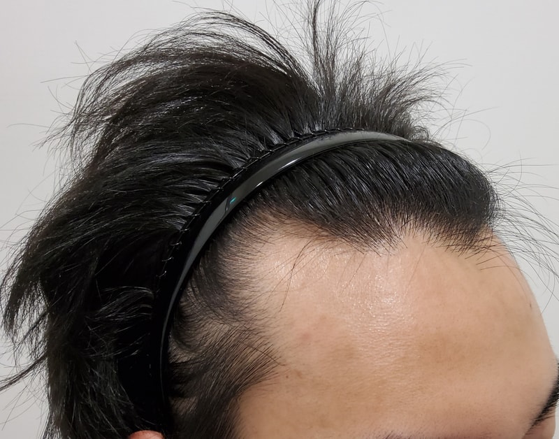 1. 수술전_3.jpg