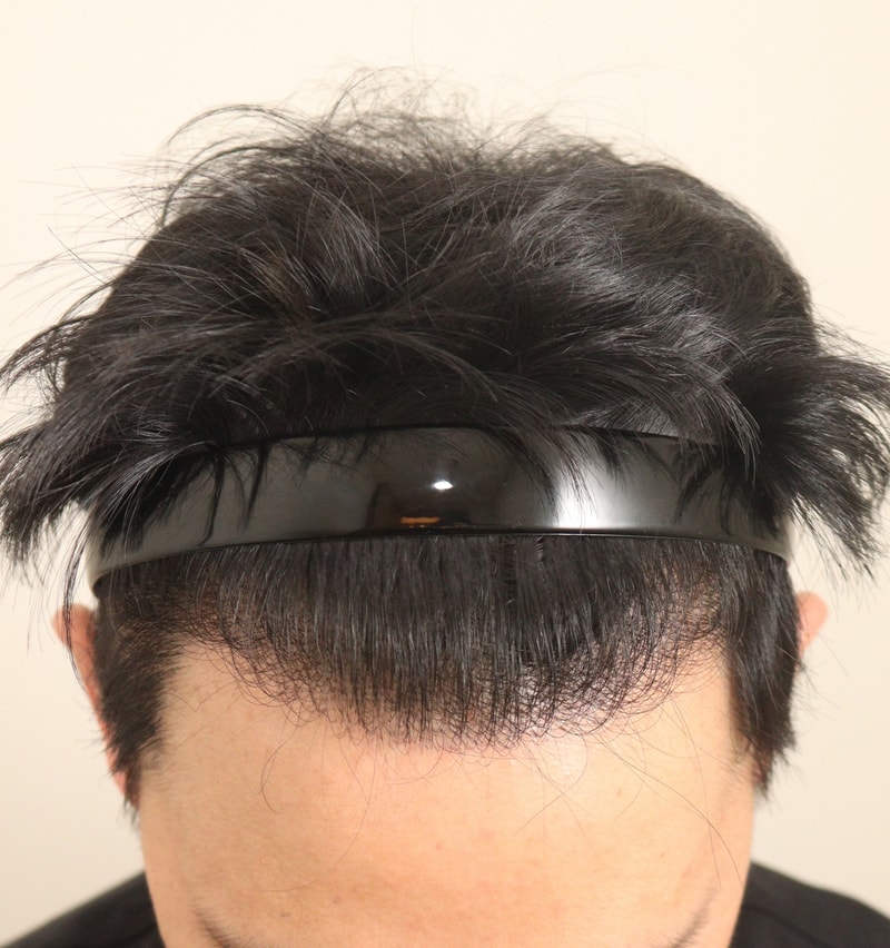 5. 수술후_1년_2.JPG