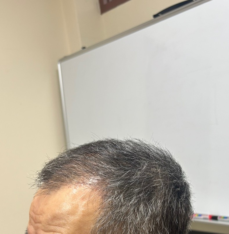 2. 수술후_3개월_셀카2.jpeg