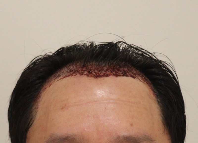 2. 수술후_1일_1.JPG