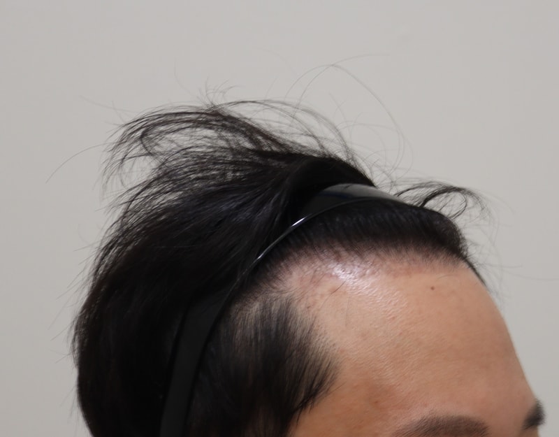 3. 수술후_3개월_3.JPG