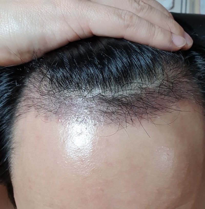 3. 수술후_3개월_셀카1.jpg