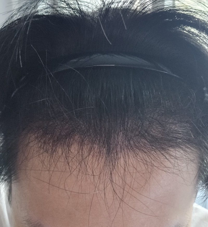 4. 수술후_6개월_셀카_1.jpg