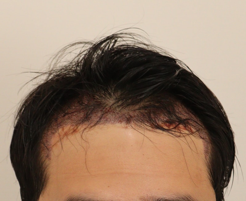 2. 수술후_1일_1.JPG