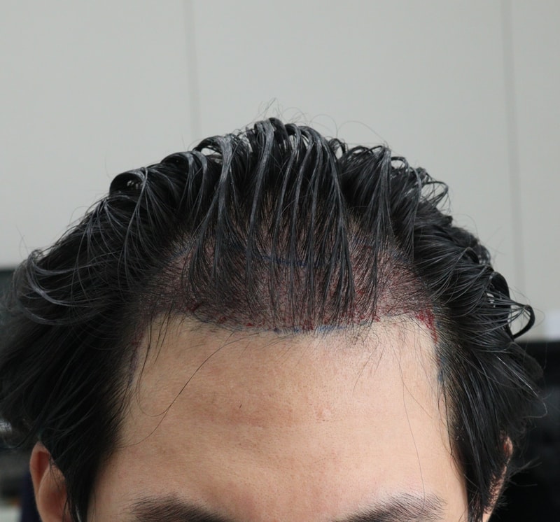 2. 수술후_당일_1.JPG