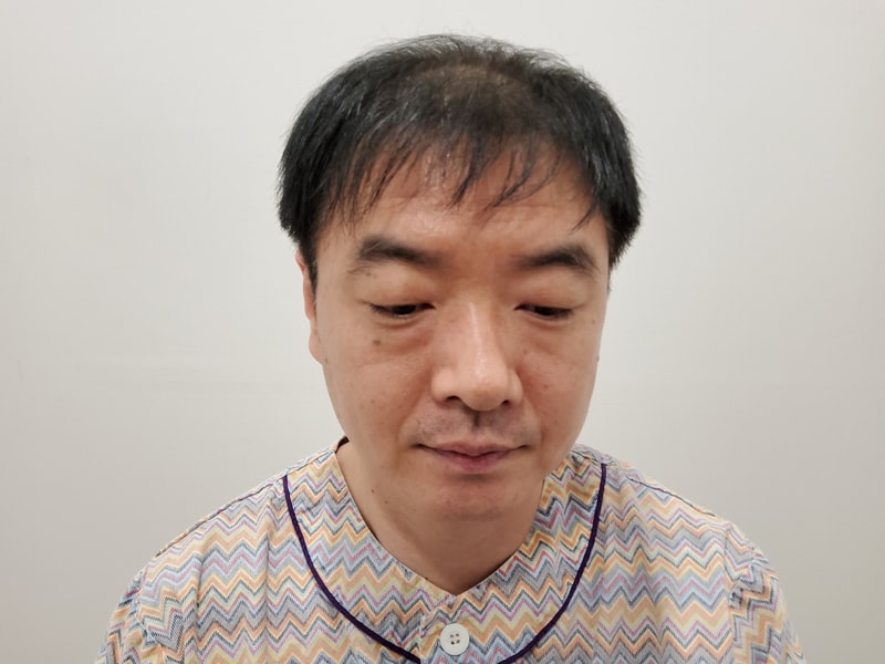 삭발하고 모발이식했습니다