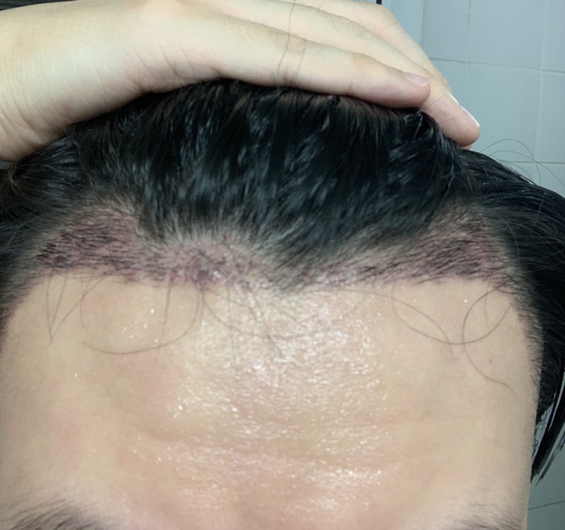 2. 수술후_2주_셀카1.jpg