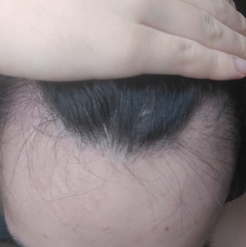 3. 수술후_3개월_셀카암흑기.jpg