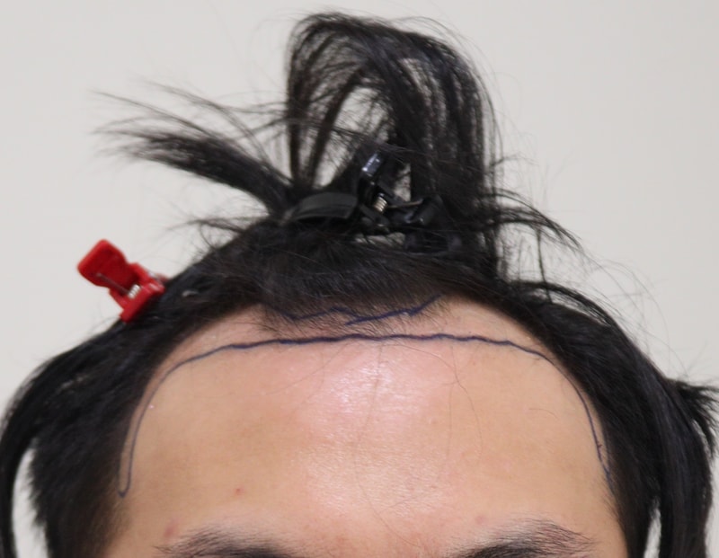 1. 수술전_1.JPG