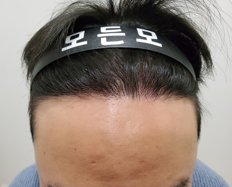5. 수술후_1년_1.jpg
