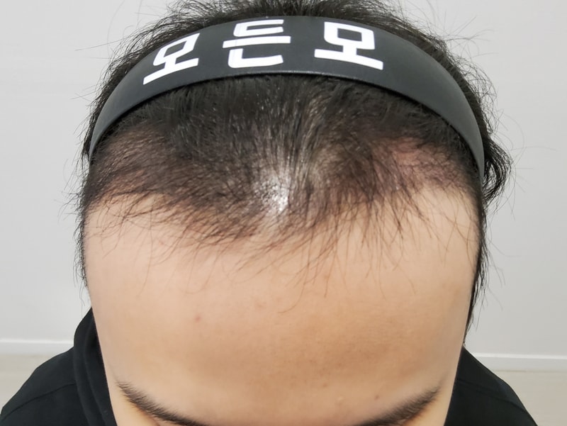3. 수술후_3개월_1.jpg