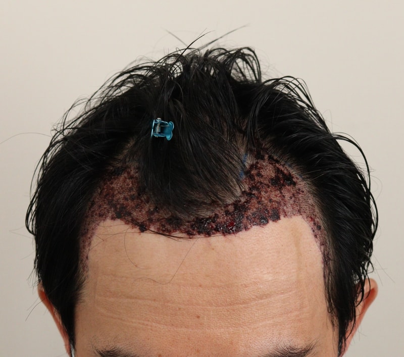 2. 수술후_1일_1.JPG