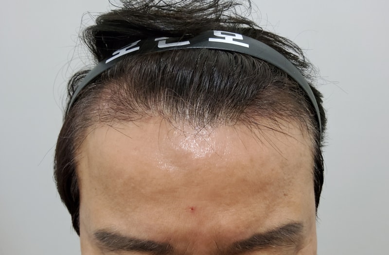 2. 수술후_3개월_1.jpg