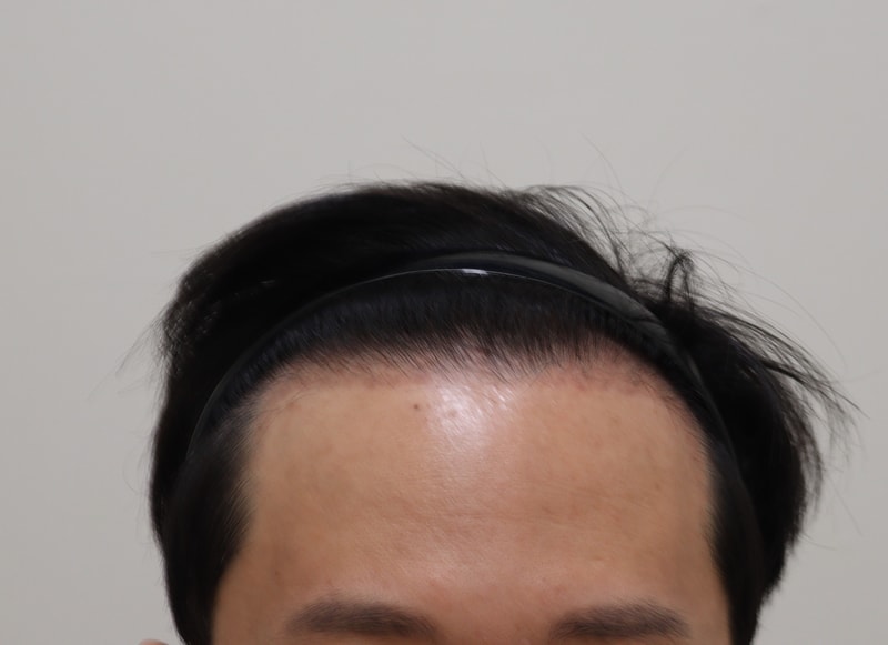 3. 수술후_3개월_1.JPG