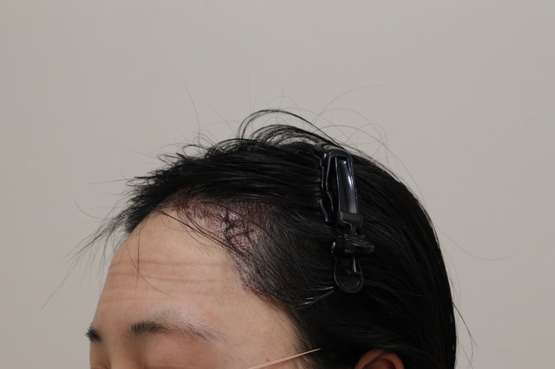 2. 수술후_2.JPG