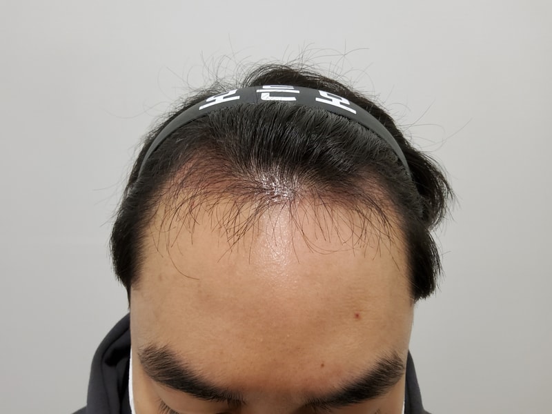 3. 수술후_3개월_1.jpg