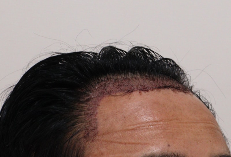 2. 수술후_1일_3.JPG