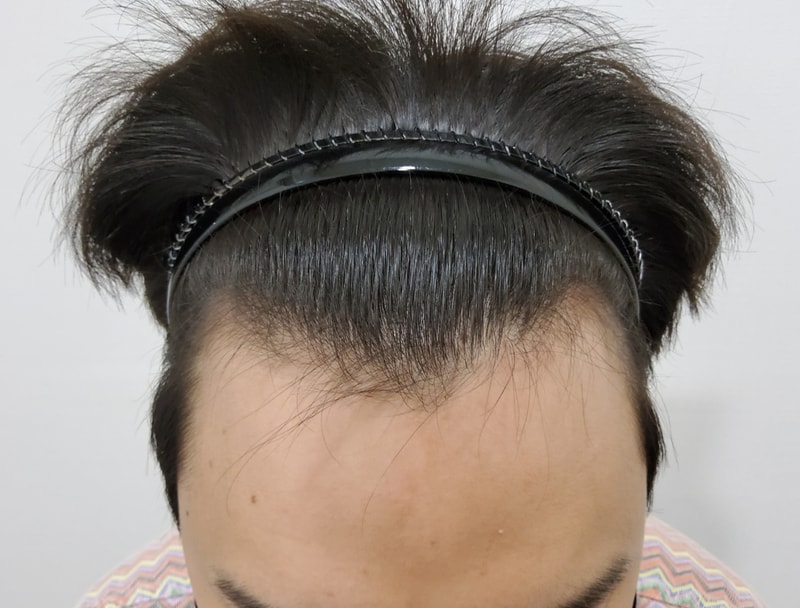 비절개 모발이식 2주 후기 남깁니다.