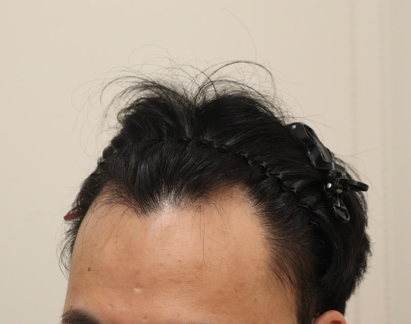 1. 수술전_2.JPG