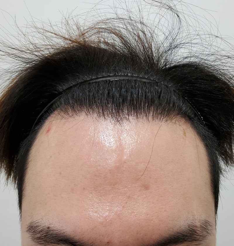 It's the first day of hair transplantation