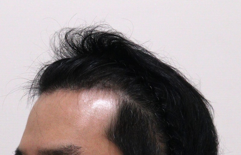 1. 수술전_2.JPG