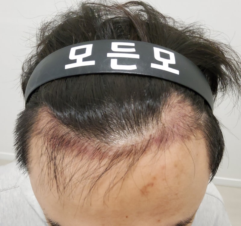 3. 수술후_3개월_2.jpg