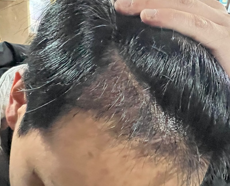 3. 수술후_3개월_셀카2.jpeg