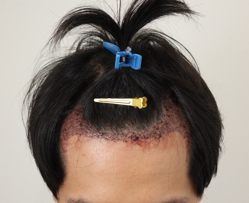 2. 수술후_1일후_2.JPG