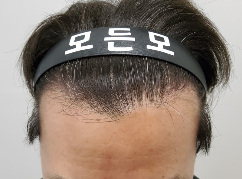 4. 수술후_6개월_1.jpg