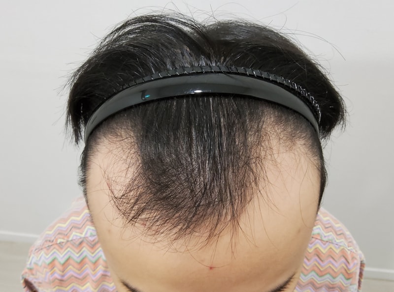 0. 수술전_1.jpg