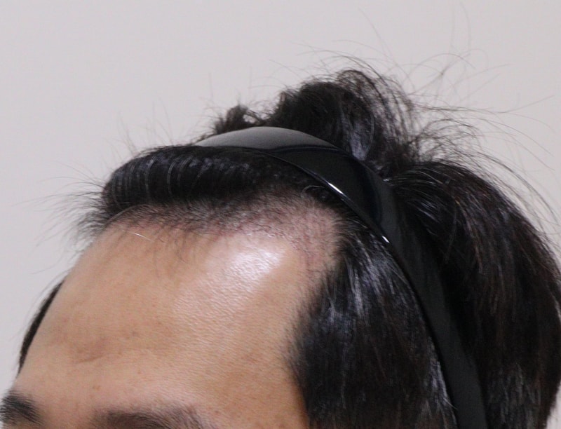 3. 수술후_3개월_2.JPG
