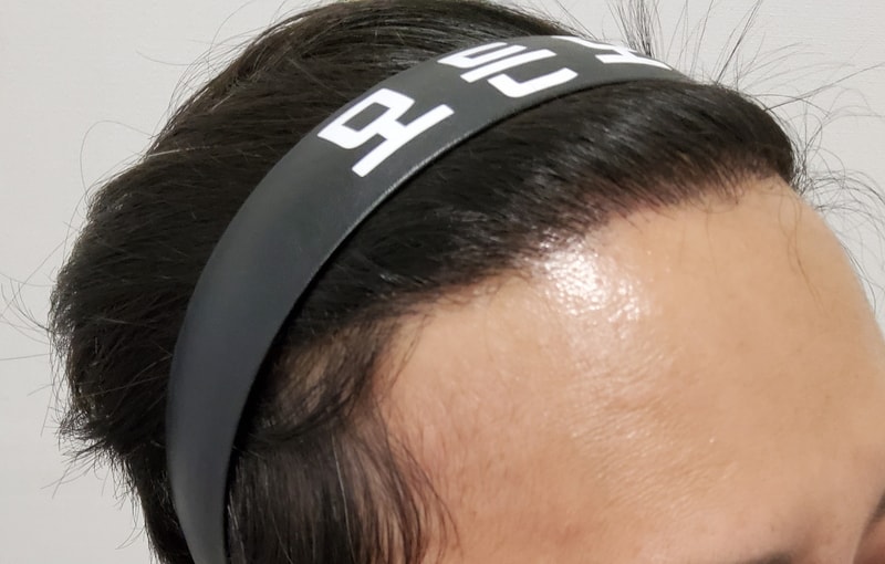 4. 수술후_6개월_3.jpg
