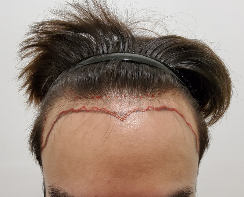 Hello, I got a hair transplant.