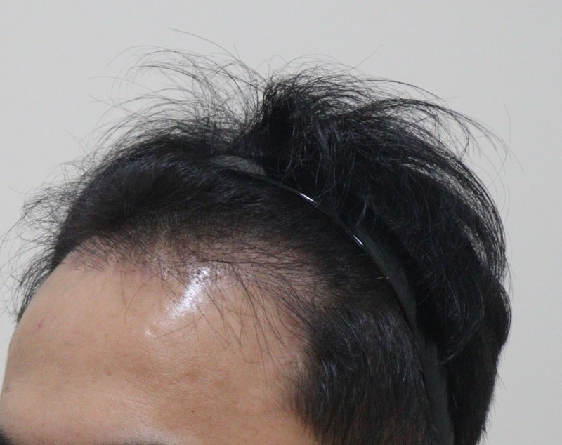 2. 수술후_3개월_2.JPG