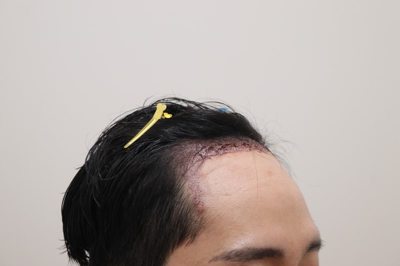 2. 수술후_1일_3.JPG