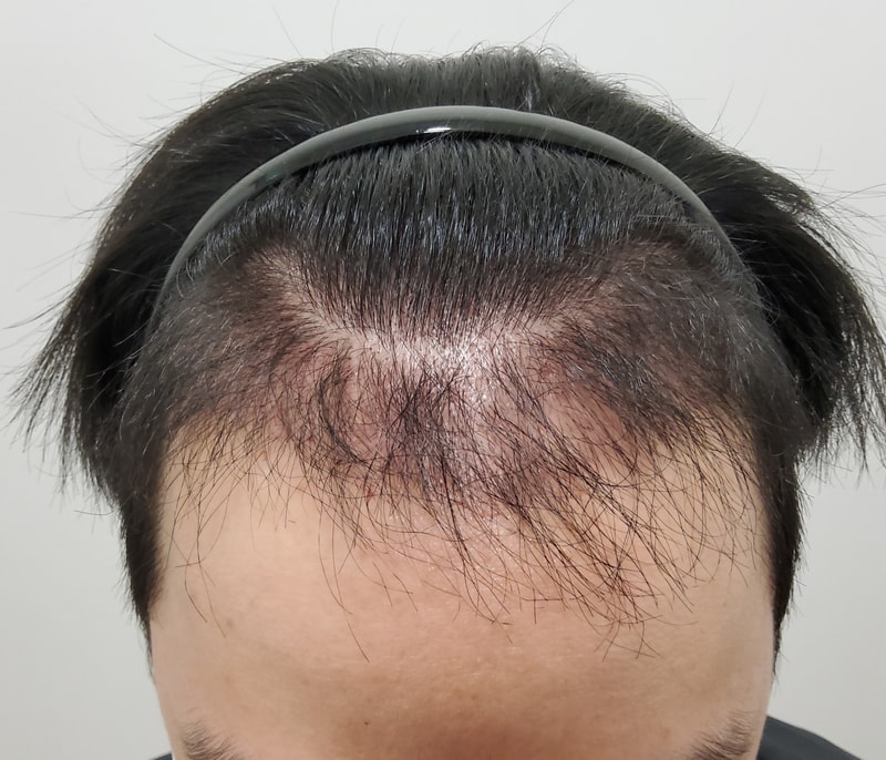 4. 수술후_3개월_1.jpg
