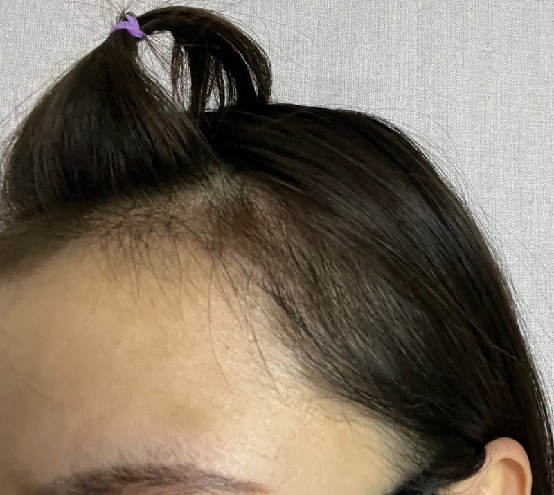 3. 수술후_3개월_셀카3.jpg