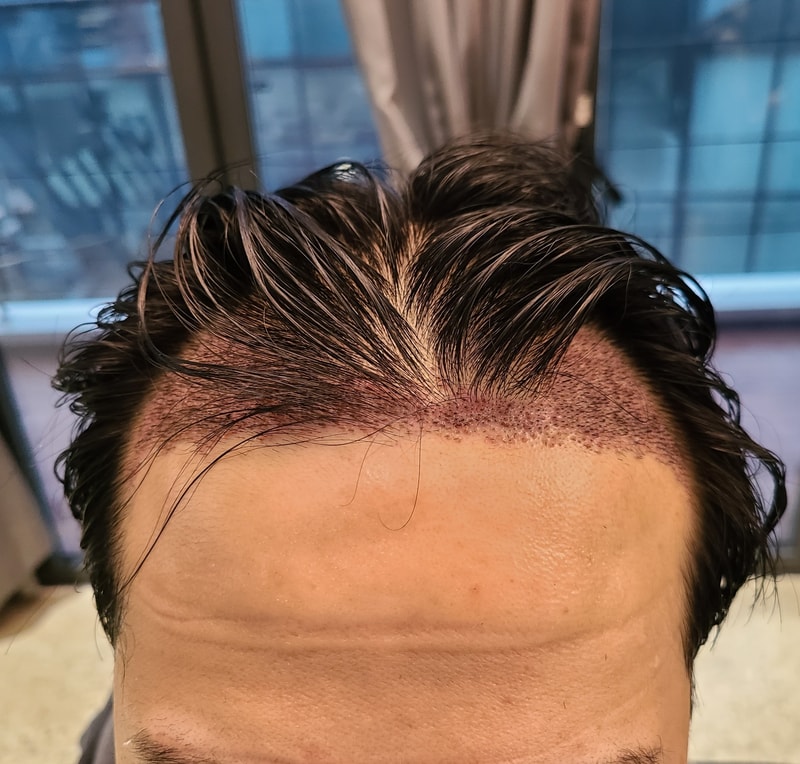 2. 수술후_1일_1.jpg