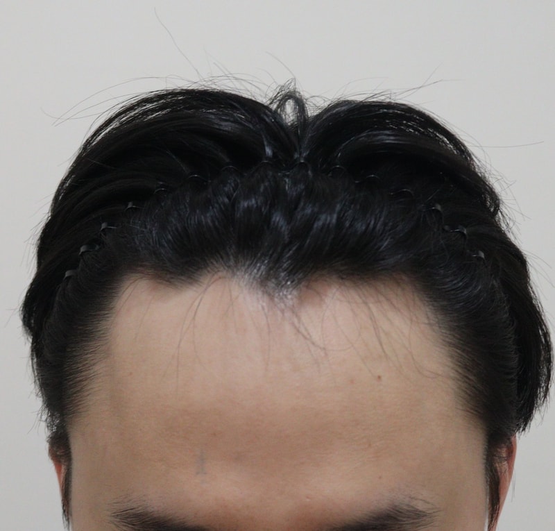 1. 수술전_2.JPG