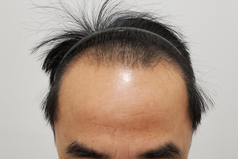 Hello, I'm finally delivering a review of the first year of hair transplantation.